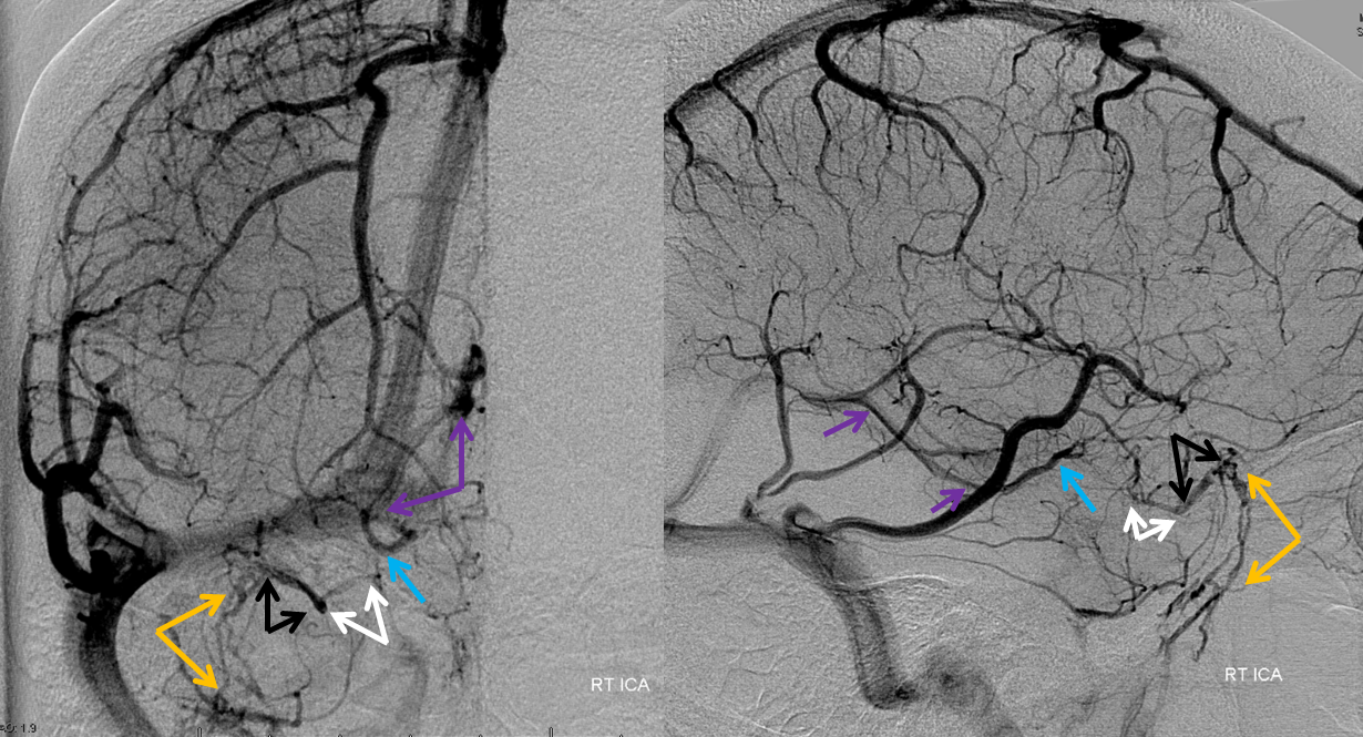 http://www.neuroangio.org/wp-content/uploads/Venous/V_cavernous_sinus_angiogram_RT_ICA.png