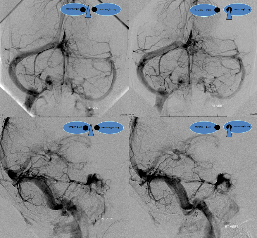 http://www.neuroangio.org/wp-content/uploads/Venous/V_cavernous_sinus_angiogram_VERT.png