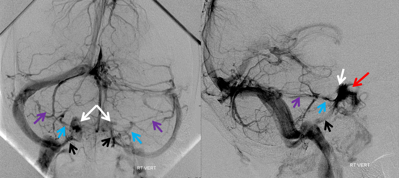 http://www.neuroangio.org/wp-content/uploads/Venous/V_cavernous_sinus_angiogram_VERT_2.png