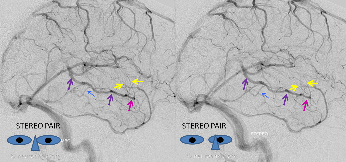 http://www.neuroangio.org/wp-content/uploads/Venous/V_cavernous_sinus_basal_vein_no_connection.png