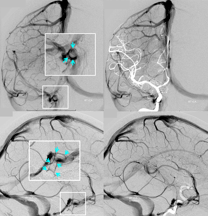 http://www.neuroangio.org/wp-content/uploads/Venous/V_cavernous_sinus_carotid_silhouette_1.png