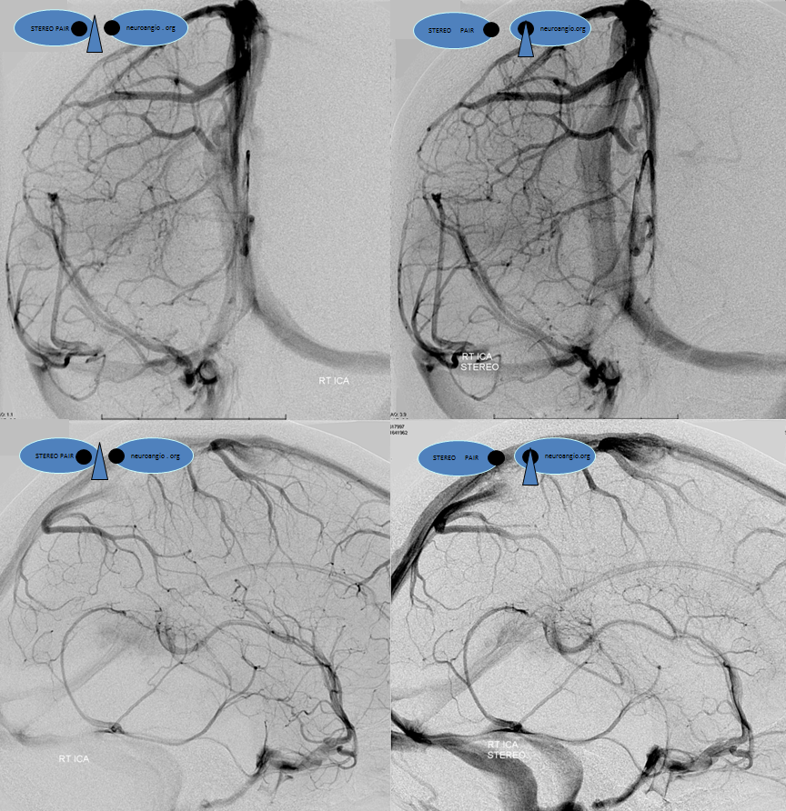 http://www.neuroangio.org/wp-content/uploads/Venous/V_cavernous_sinus_carotid_silhouette_2.png