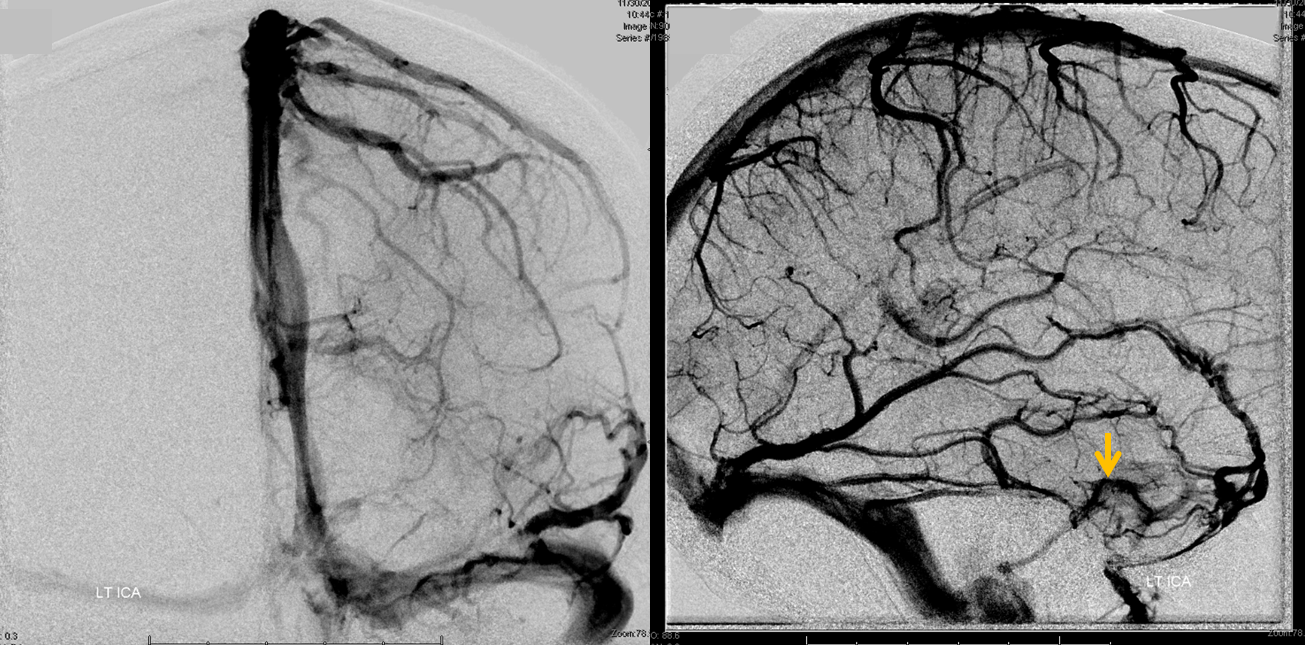 cavernous sinus SOV