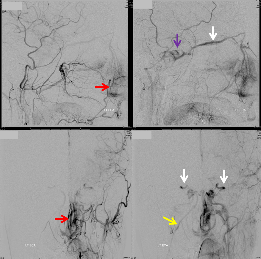 cavernous sinus SOV