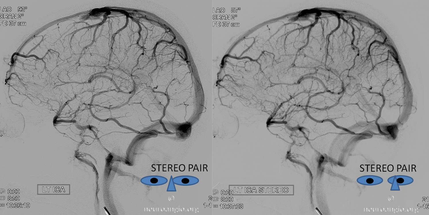 http://www.neuroangio.org/wp-content/uploads/Venous/V_cavernous_sinus_stereo_full_basal_vein_1.png