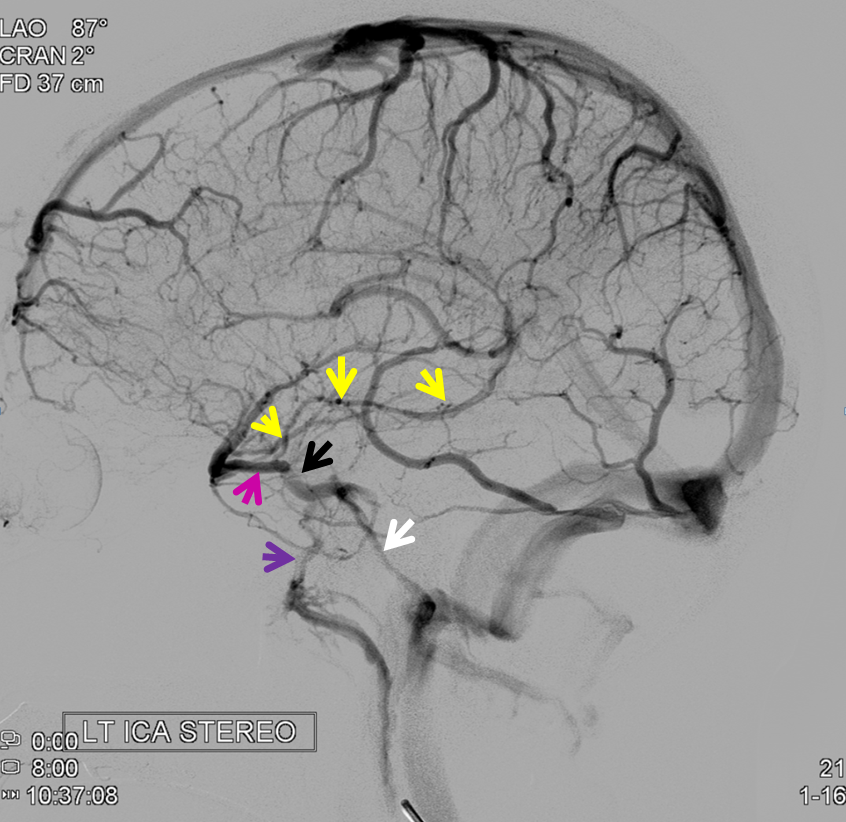 http://www.neuroangio.org/wp-content/uploads/Venous/V_cavernous_sinus_stereo_full_basal_vein_2.png