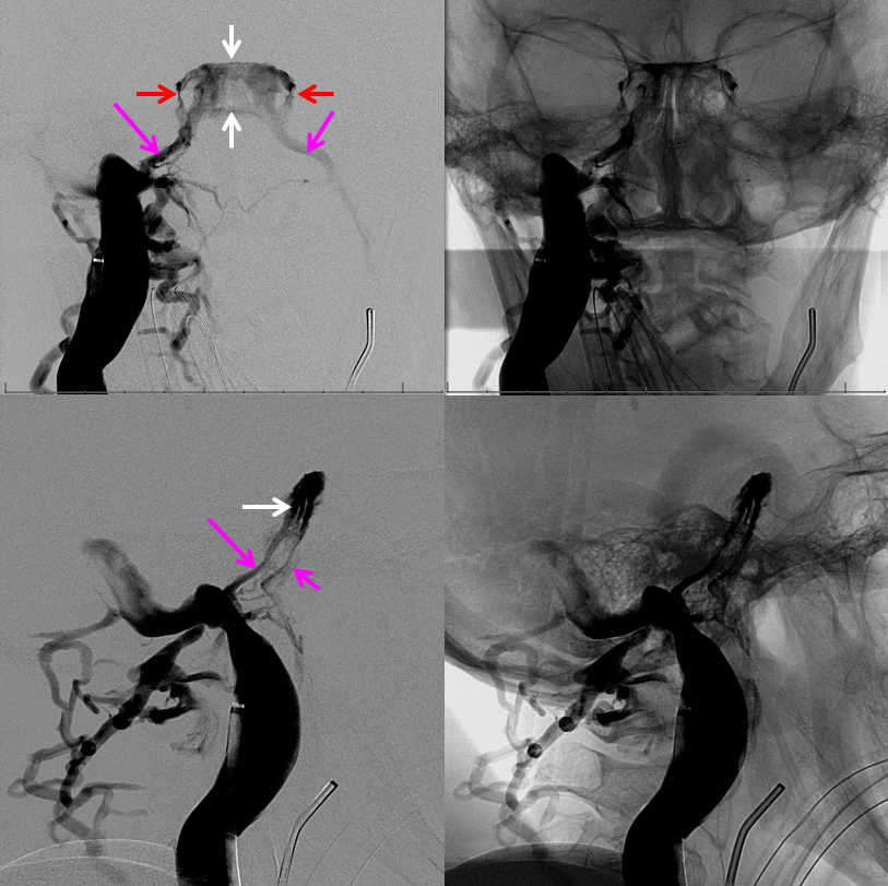 http://www.neuroangio.org/wp-content/uploads/Venous/V_cavernous_sinus_venogram.png