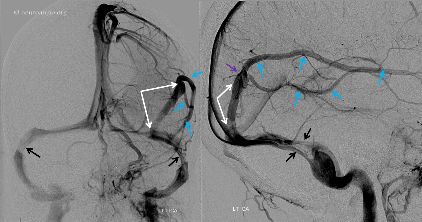 http://www.neuroangio.org/wp-content/uploads/Venous/V_dural_sinus_supratentorial_1.png