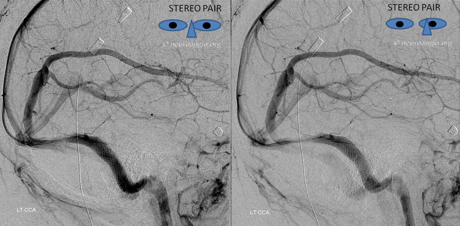 http://www.neuroangio.org/wp-content/uploads/Venous/V_dural_sinus_supratentorial_2.png