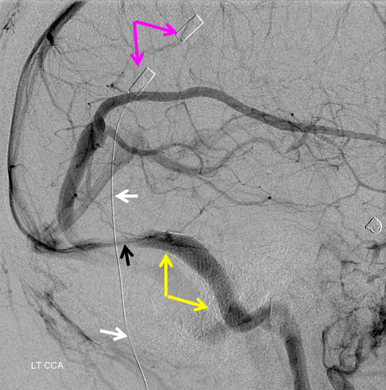 http://www.neuroangio.org/wp-content/uploads/Venous/V_dural_sinus_supratentorial_3.png