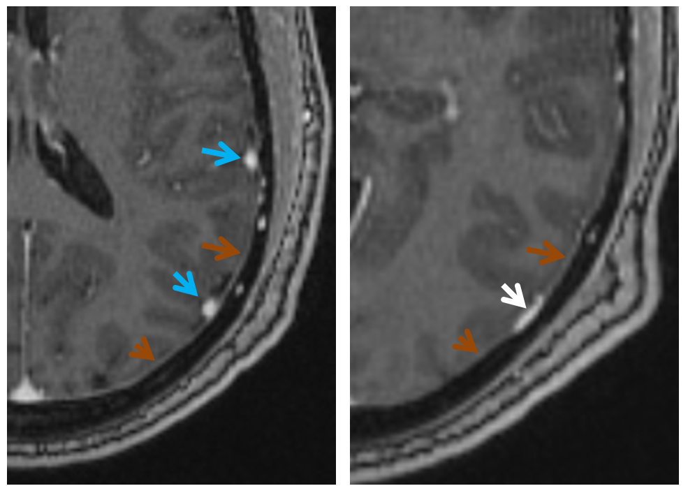 dural sinus MRI