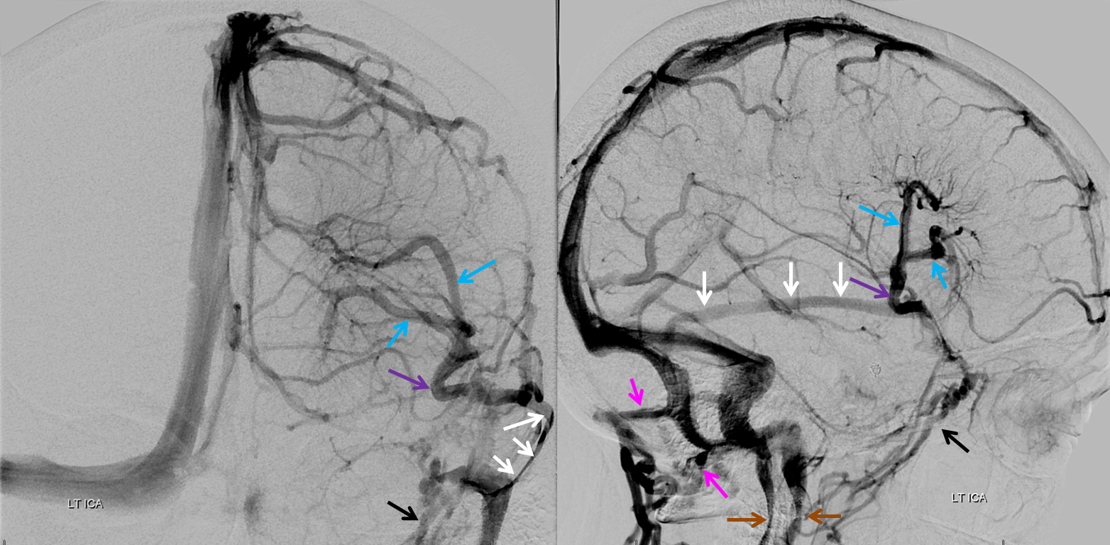 dural sinus and dva