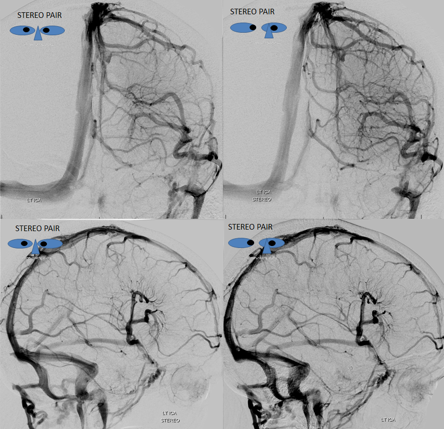 dural sinus and dva