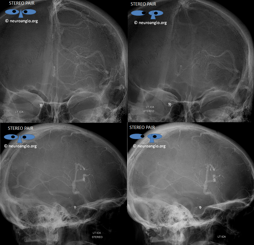 dural sinus and dva