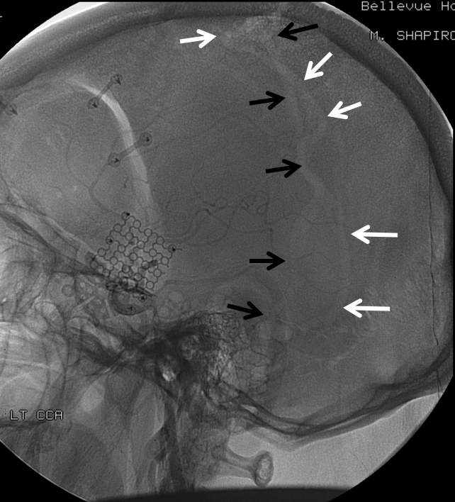 http://www.neuroangio.org/wp-content/uploads/Venous/V_emissary_veins_parietal_0.png