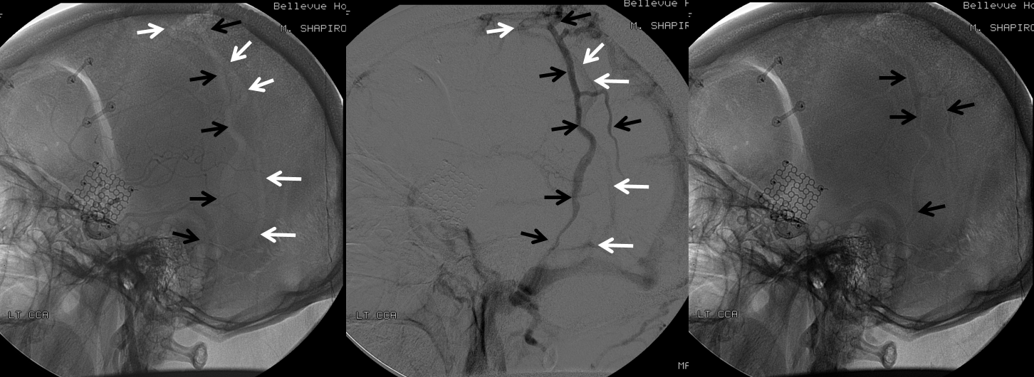 http://www.neuroangio.org/wp-content/uploads/Venous/V_emissary_veins_parietal_1.png