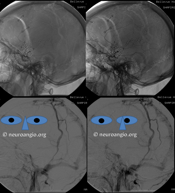 http://www.neuroangio.org/wp-content/uploads/Venous/V_emissary_veins_parietal_2.png http://www.neuroangio.org/wp-content/uploads/Venous/V_emissary_veins_parietal_2.png