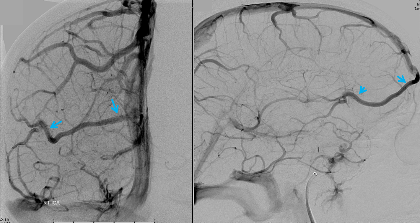 large frontal vein