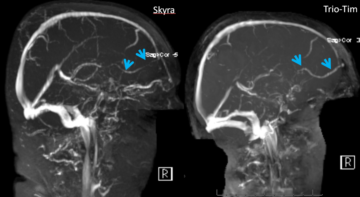 mrv frontal vein