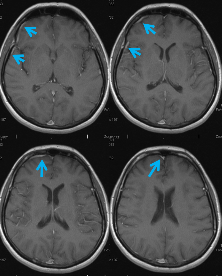 frontal veins