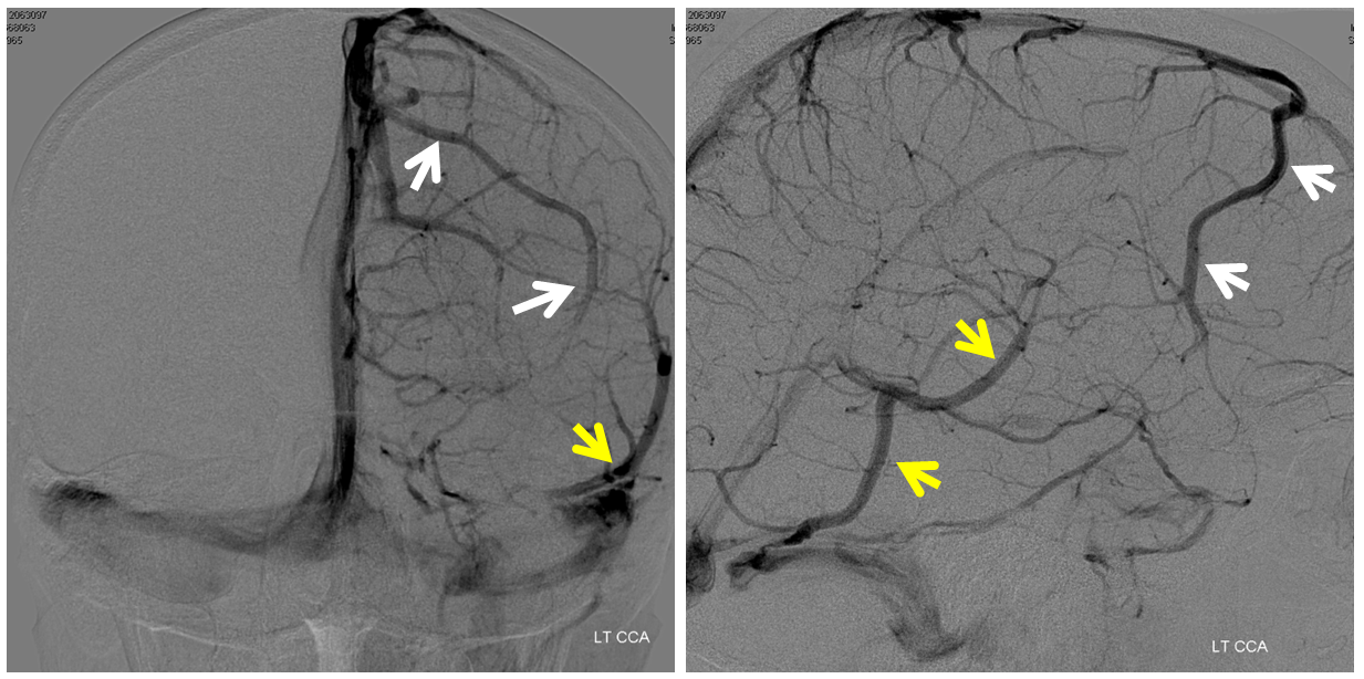 frontal veins