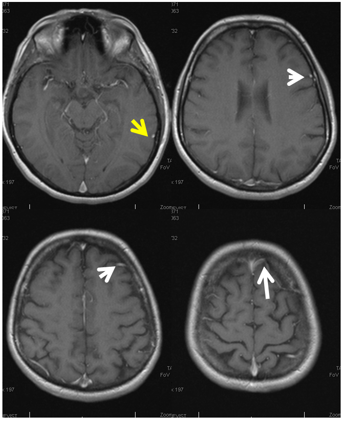 mrv frontal vein