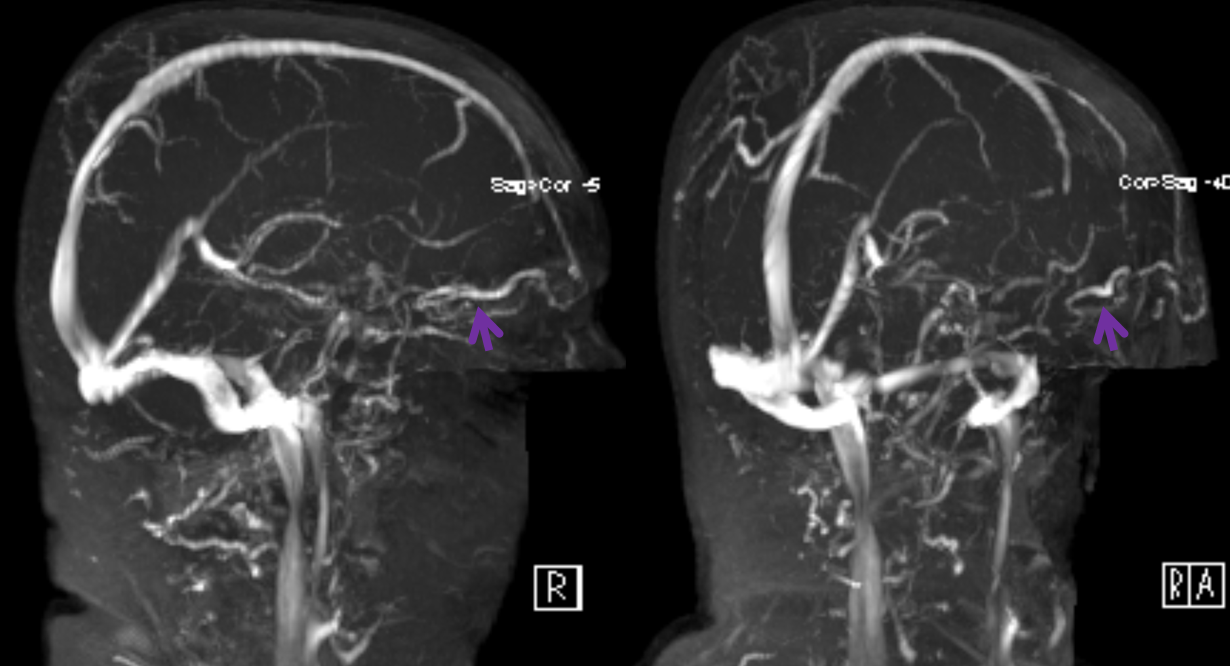 frontal veins