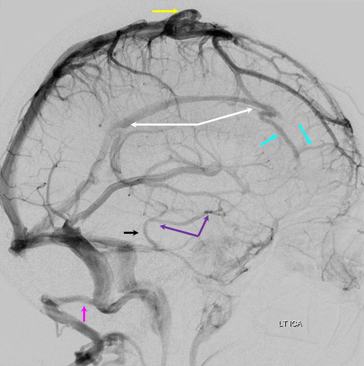 Venous Sinuses | neuroangio.org