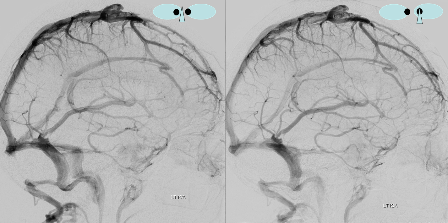 Inferior Sagittal Sinus