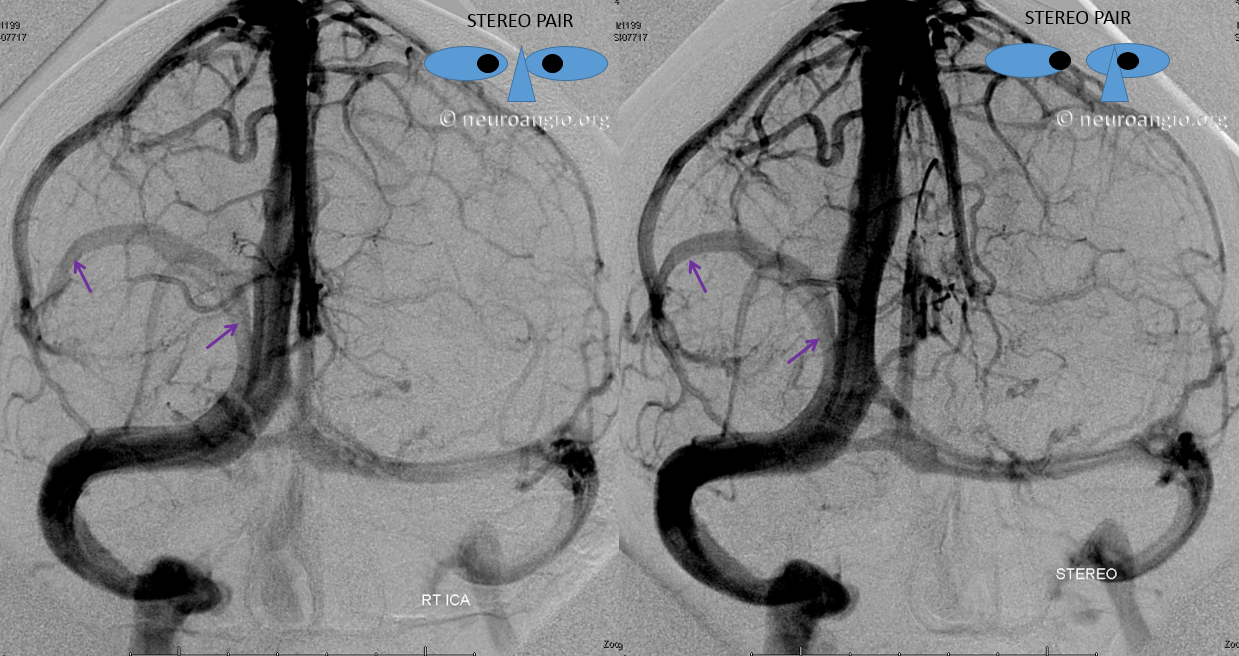 http://www.neuroangio.org/wp-content/uploads/Venous/V_parieto-occipital-dural-sinus-01.png