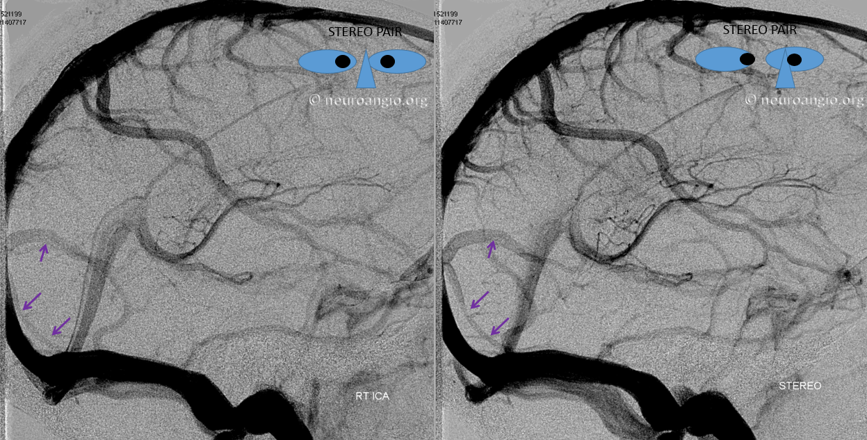 http://www.neuroangio.org/wp-content/uploads/Venous/V_parieto-occipital-dural-sinus-02.png