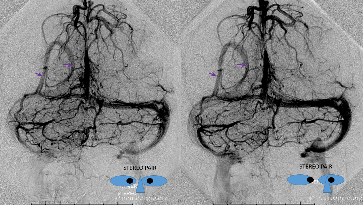 http://www.neuroangio.org/wp-content/uploads/Venous/V_parieto-occipital-dural-sinus-03.png