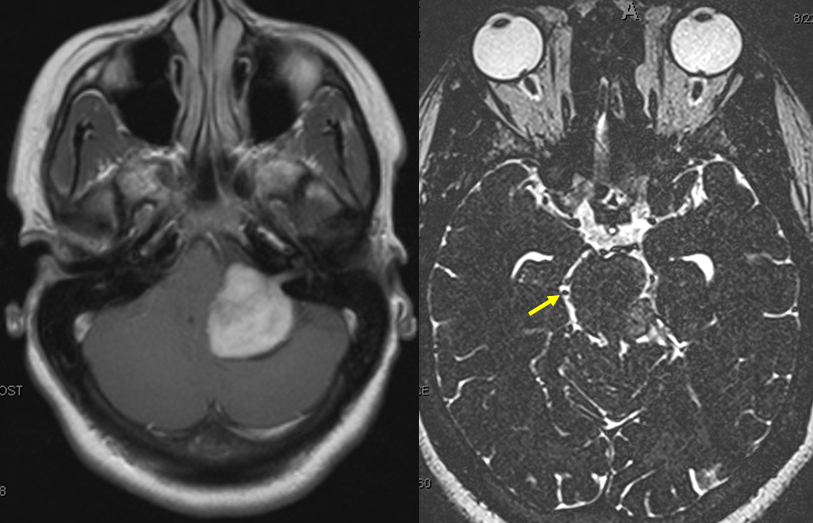 V_posterior_fossa_anterior_group_and_interpeduncular_MRI.png