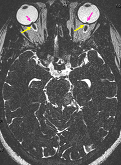 V_posterior_fossa_anterior_group_and_interpeduncular_MRI_papilledema.png