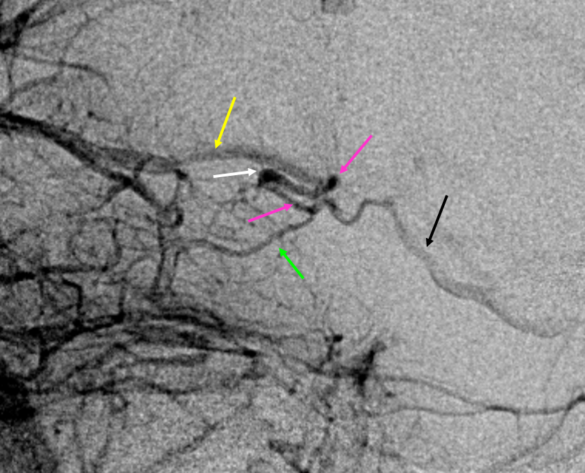 V_posterior_fossa_anterior_group_and_interpeduncular_angio_detail.png