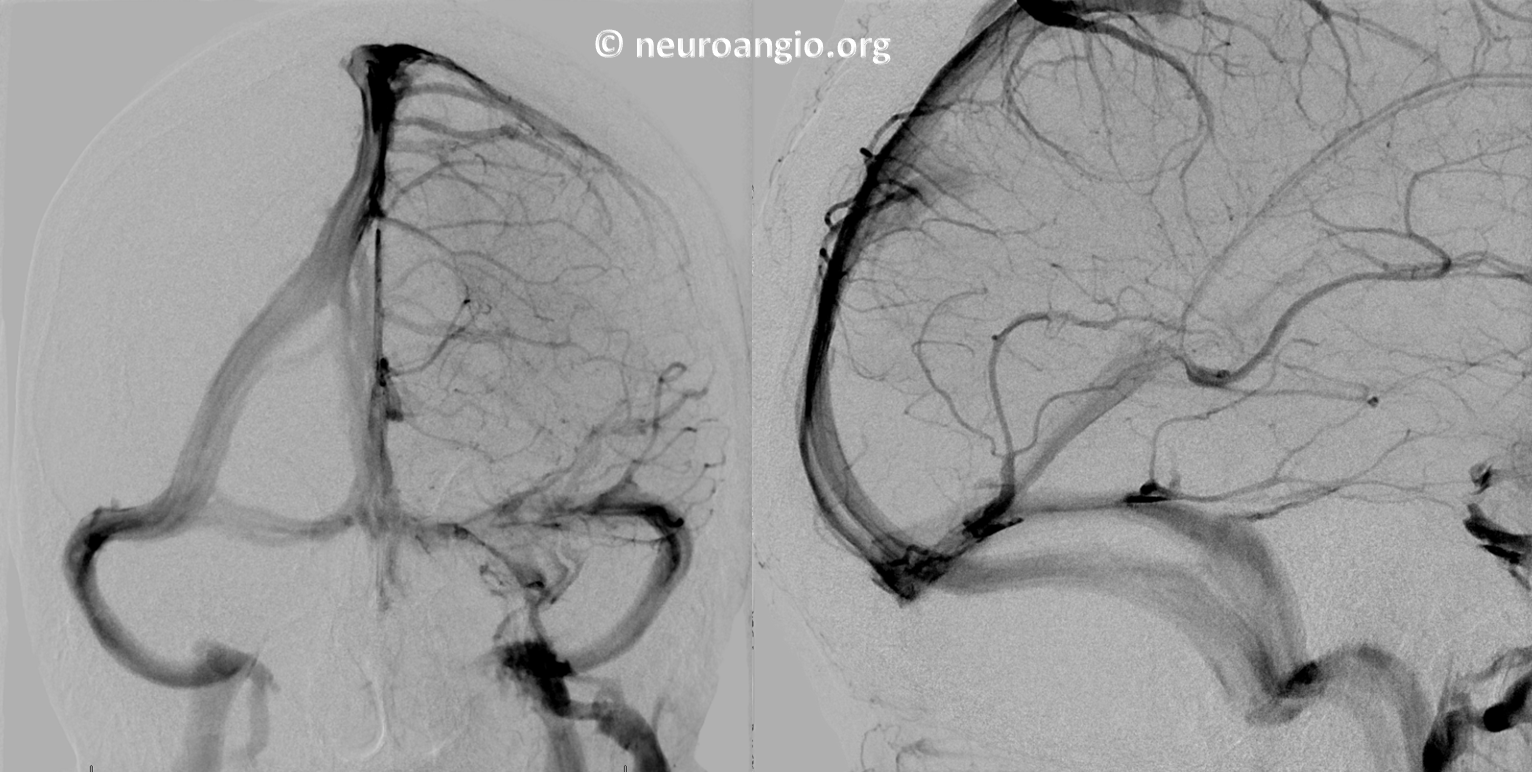 Sagittal Sinus off Midline Angulation