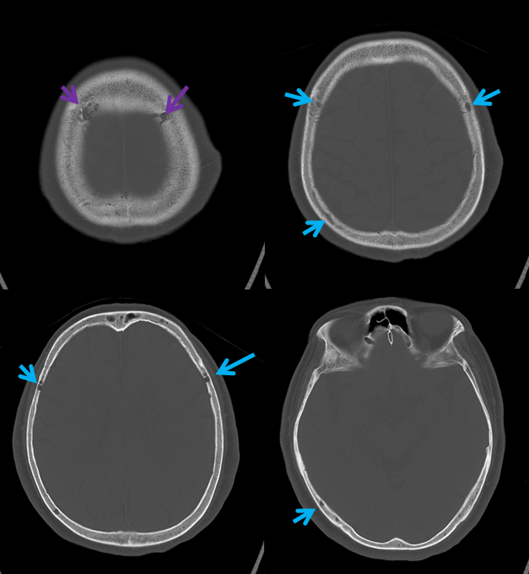 http://www.neuroangio.org/wp-content/uploads/Venous/V_sinuses_emissary_veins_convexity_1.png