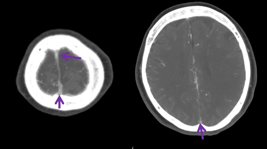 http://www.neuroangio.org/wp-content/uploads/Venous/V_sinuses_emissary_veins_convexity_2.png