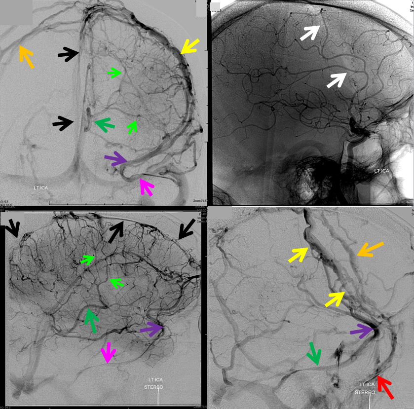 http://www.neuroangio.org/wp-content/uploads/Venous/V_sinuses_emissary_veins_convexity_3.png