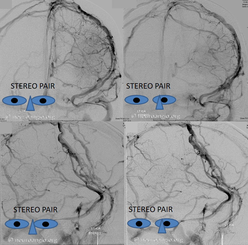 http://www.neuroangio.org/wp-content/uploads/Venous/V_sinuses_emissary_veins_convexity_4.png