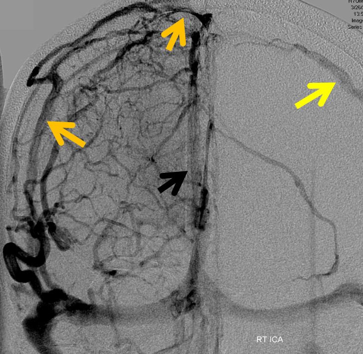 http://www.neuroangio.org/wp-content/uploads/Venous/V_sinuses_emissary_veins_convexity_5.png