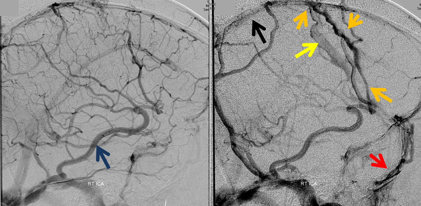 http://www.neuroangio.org/wp-content/uploads/Venous/V_sinuses_emissary_veins_convexity_6.png