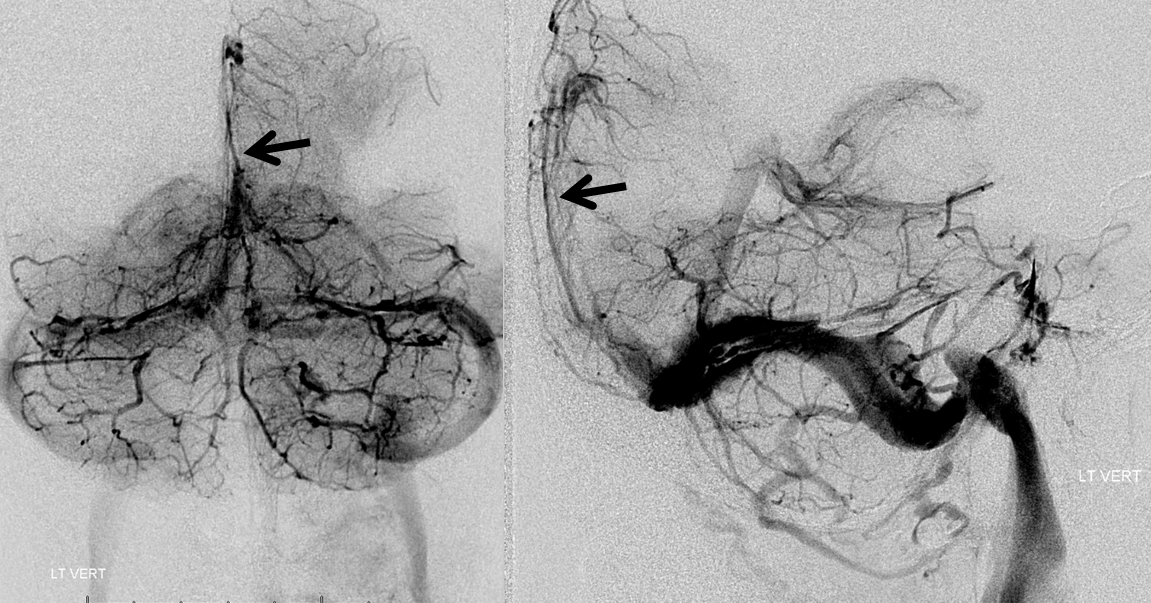 http://www.neuroangio.org/wp-content/uploads/Venous/V_sinuses_emissary_veins_convexity_7.png