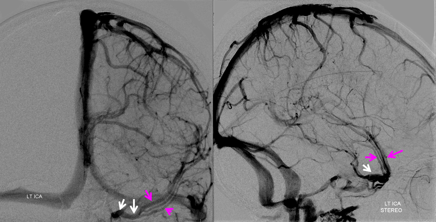 http://www.neuroangio.org/wp-content/uploads/Venous/V_sylvian_veins_no_sphenoparietal_sinus_1.png