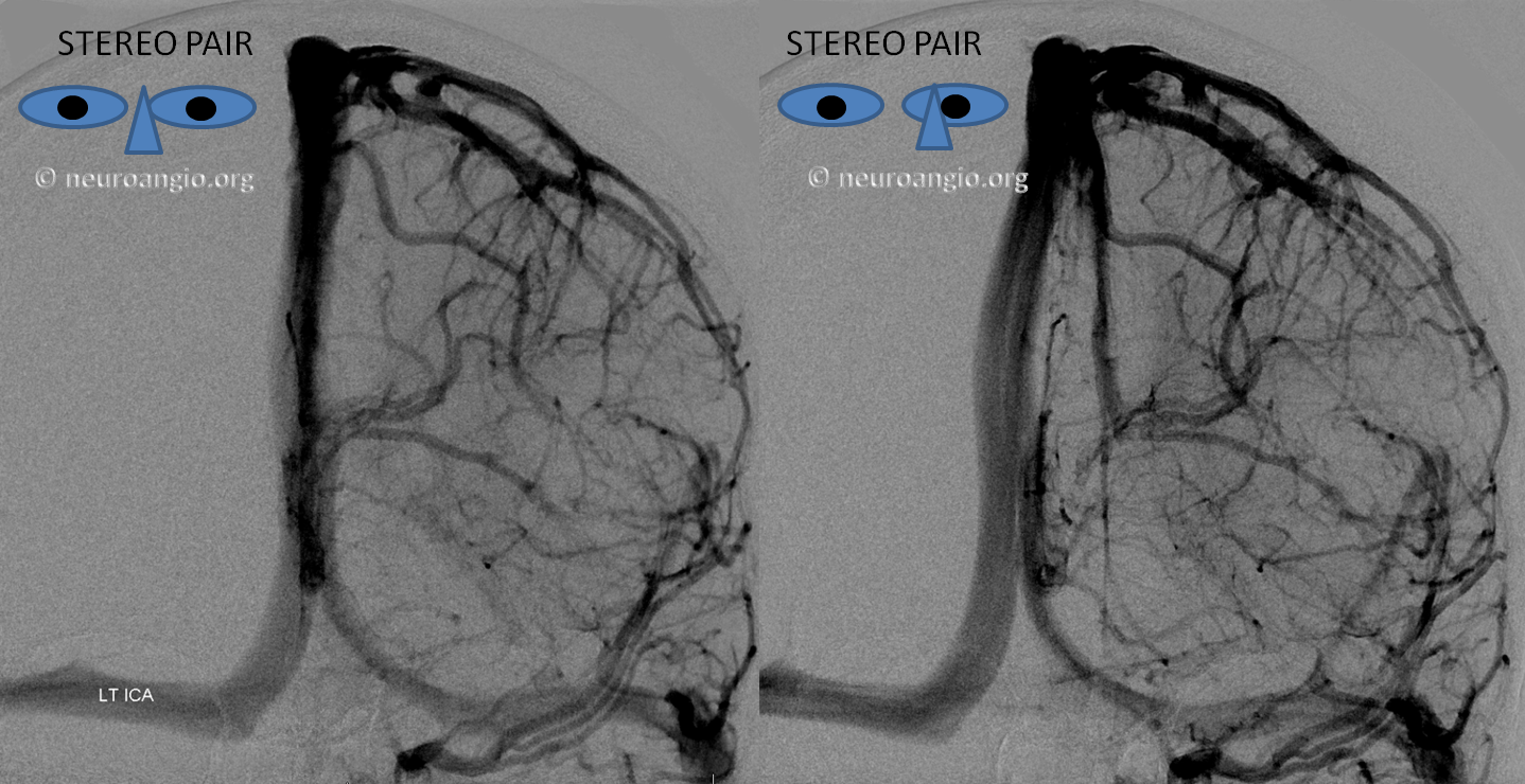 http://www.neuroangio.org/wp-content/uploads/Venous/V_sylvian_veins_no_sphenoparietal_sinus_2.png