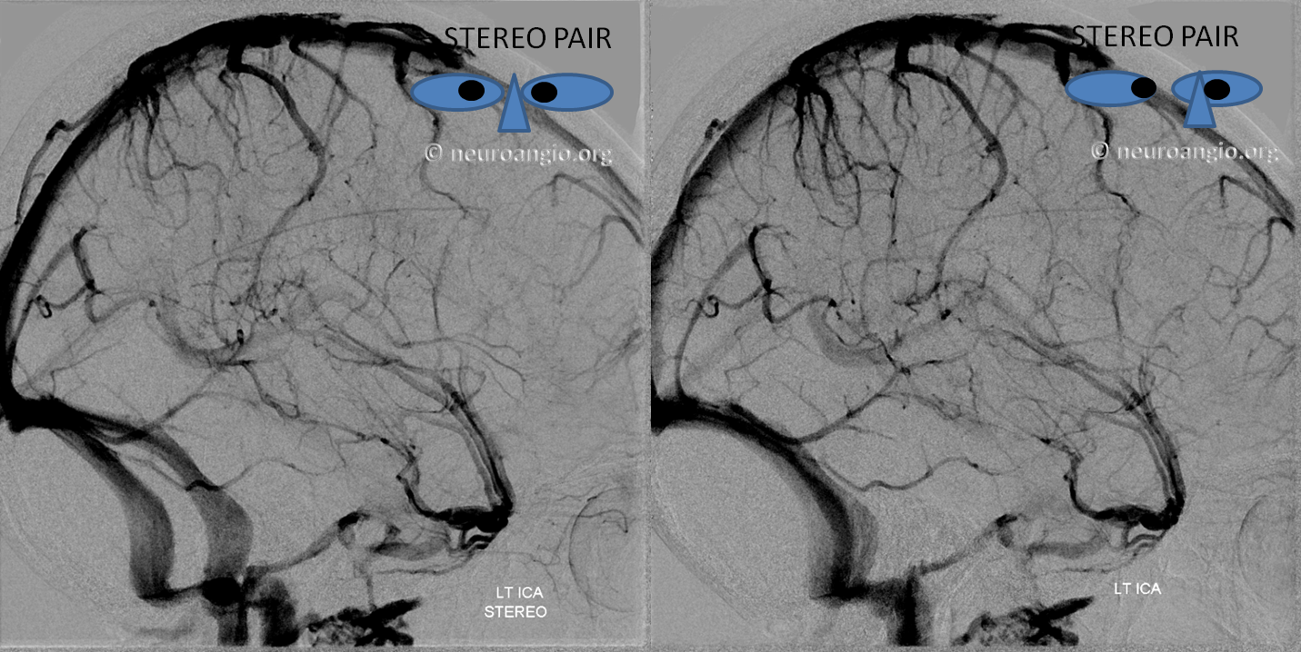 http://www.neuroangio.org/wp-content/uploads/Venous/V_sylvian_veins_no_sphenoparietal_sinus_3.png