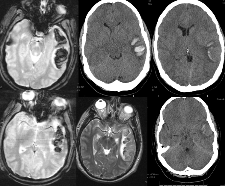 cortical vein thrombosis