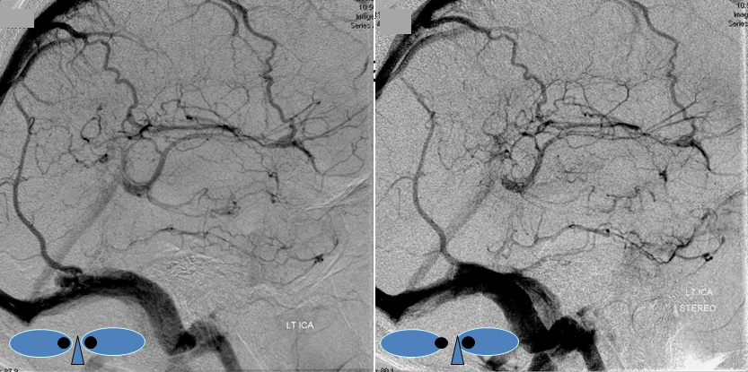 LT Temporal hematoma angio stereo