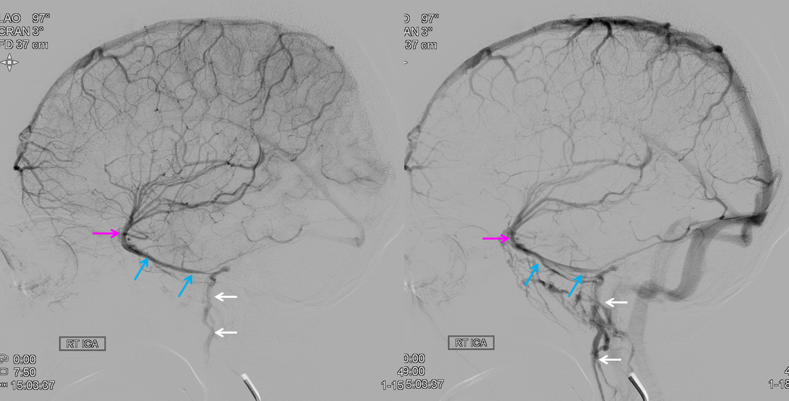 http://www.neuroangio.org/wp-content/uploads/Venous/V_tentorial_sinus_foramen_spinosum_1.png