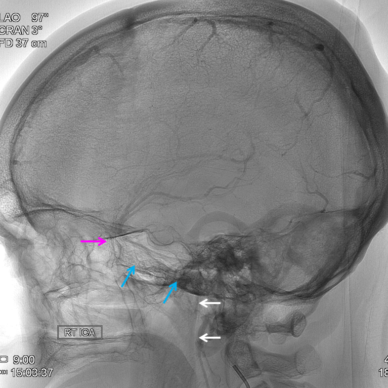 http://www.neuroangio.org/wp-content/uploads/Venous/V_tentorial_sinus_foramen_spinosum_2.png